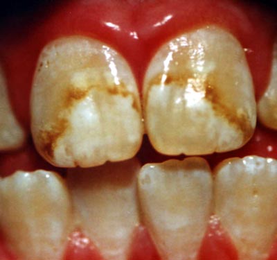 Dental Fluorosis