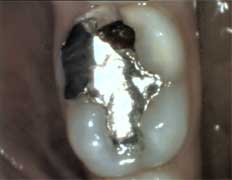 Mercury Dental Filling